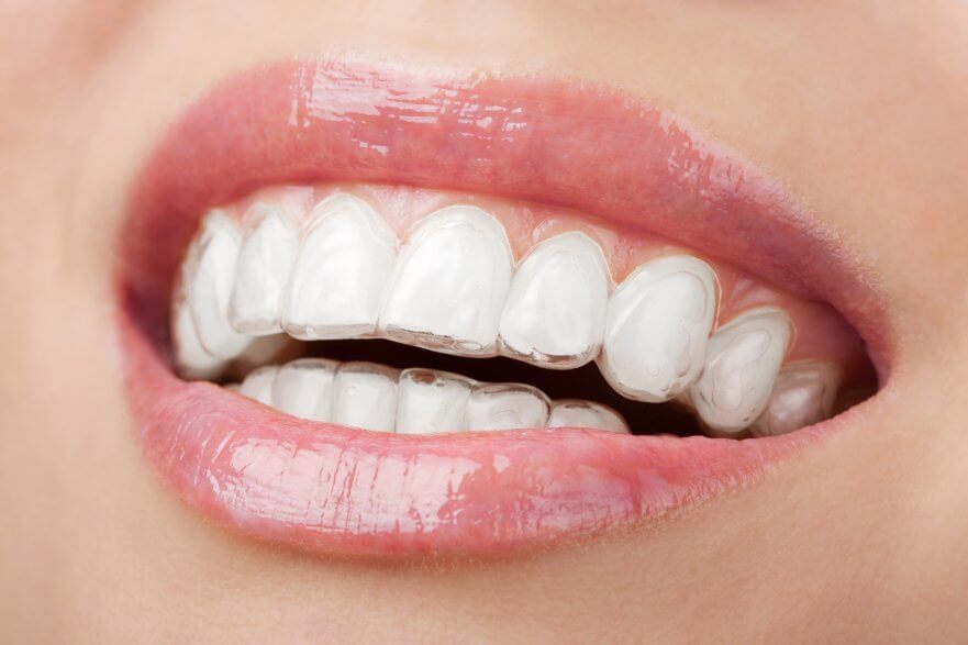 Invisible Braces - Best Orthodontist NYC
