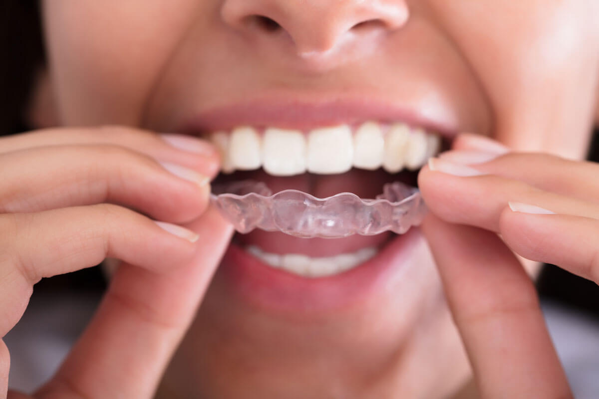 Invisalign Treatment: Everything You Need to Know - Elite Dental Care